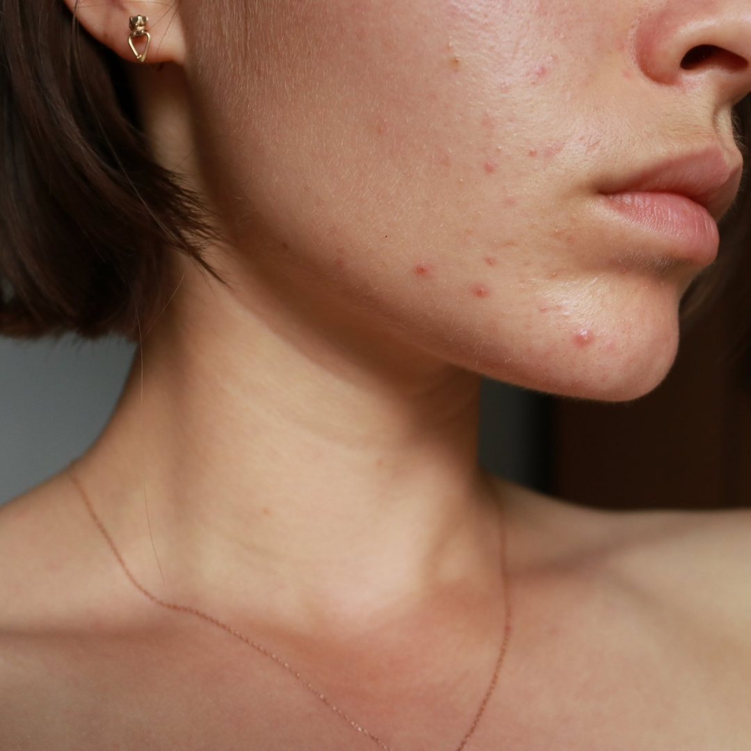 Acne Attack: A Guide to Battling Breakouts and Winning the War