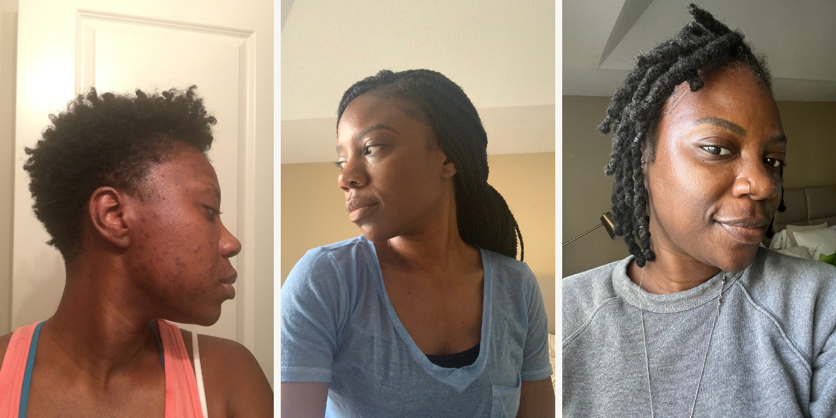 picture of skin transformation